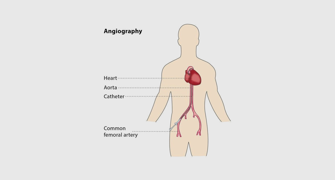angiography
