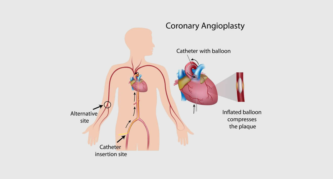 angioplasty
